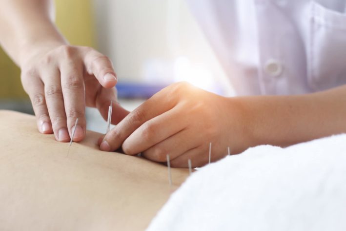 hands performing acupuncture to patient